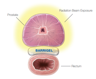 Barrigel Spacer - Men's Health Clinic KINGSTON